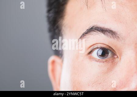 Nahaufnahme des Auges eines Diabetikers, symbolisiert das Risiko einer diabetischen Retinopathie und Makuladegeneration. Betont die Bedeutung der Augengesundheit Stockfoto