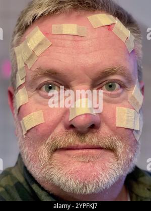 Mann mit vielen kleinen Wundflecken im Gesicht, nach einer Laserbehandlung beim Dermatologen, wegen Basalzellkarzinom, weißem Hautkrebs, verdächtigen s Stockfoto