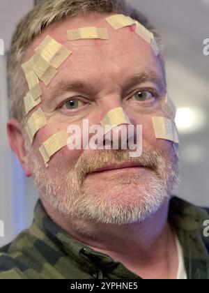 Mann mit vielen kleinen Wundflecken im Gesicht, nach einer Laserbehandlung beim Dermatologen, wegen Basalzellkarzinom, weißem Hautkrebs, verdächtigen s Stockfoto