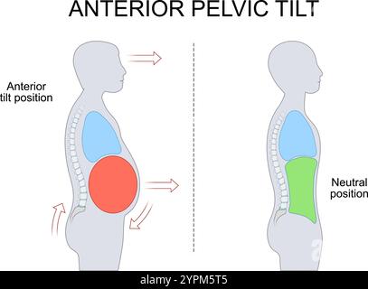 Beckenneigung vorne. Beckenrotation. Lumbale Lordose. Haltungsungleichgewicht. Bauchmuskelschwäche. Schmerzen im unteren Rücken. Physiotherapie. Beckenkorre Stock Vektor