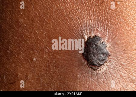 Nahaufnahme des Melanomhautkrebses, der auf menschlicher Haut wächst Stockfoto