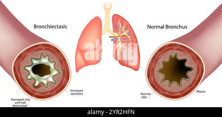 Bronchiektasen und normaler Bronchus. Erhöhter Sekretionsschleim. Wand zerstörte und beschädigte Zilien Stock Vektor
