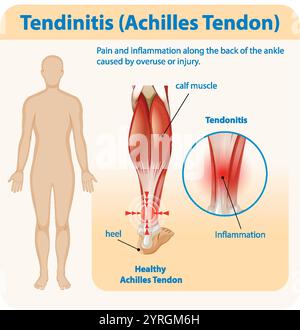 Diagramm mit Entzündung und Schmerzen der Achillessehne Stock Vektor