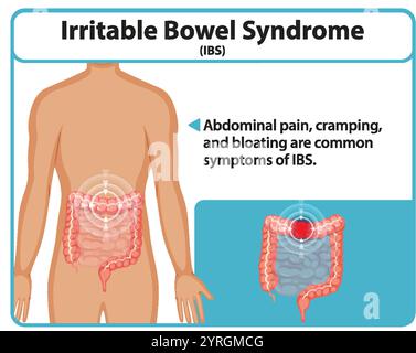 Abbildung der Symptome des RDS und der betroffenen Bereiche Stock Vektor