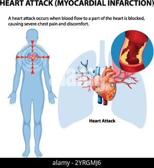 Illustration von Herzinfarktsymptomen und -Ursachen Stock Vektor