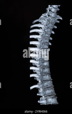 Spinale mrt-Bilder Stockfoto