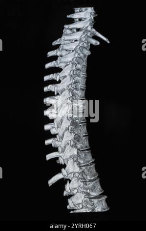 Spinale mrt-Bilder Stockfoto