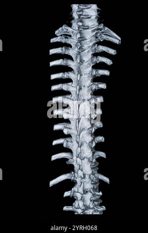 Spinale mrt-Bilder Stockfoto