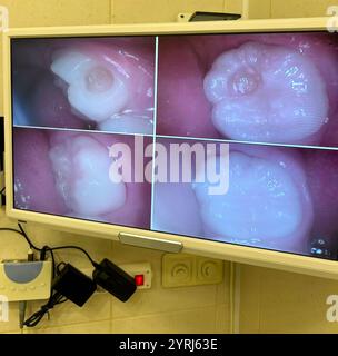 Karies behandeln. Zahnärztliche Behandlung beim Zahnarzt. Eine Füllung auf einen Zahn auflegen. Vorher und nachher. Monitor in der Zahnarztpraxis. Anzeige des Ergebnisses für den Patienten. Mundpflege Stockfoto