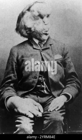 Joseph Carey Merrick (5. August 1862 ? 11. April 1890), oft fälschlicherweise John Merrick genannt, war ein Engländer, der für schwere Deformitäten bekannt war. Er wurde zunächst in einer Freak-Show als „Elephant man“ ausgestellt und lebte dann im London Hospital, nachdem er Frederick Treves kennengelernt hatte, und wurde später in der Londoner Gesellschaft bekannt. Stockfoto