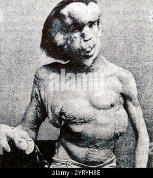 Joseph Carey Merrick (5. August 1862 ? 11. April 1890), oft fälschlicherweise John Merrick genannt, war ein Engländer, der für schwere Deformitäten bekannt war. Er wurde zunächst in einer Freak-Show als „Elephant man“ ausgestellt und lebte dann im London Hospital, nachdem er Frederick Treves kennengelernt hatte, und wurde später in der Londoner Gesellschaft bekannt. Stockfoto