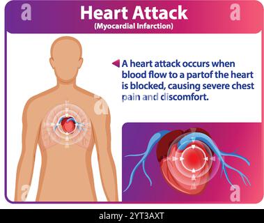 Illustration des Herzinfarktes und seiner Wirkungen Stock Vektor