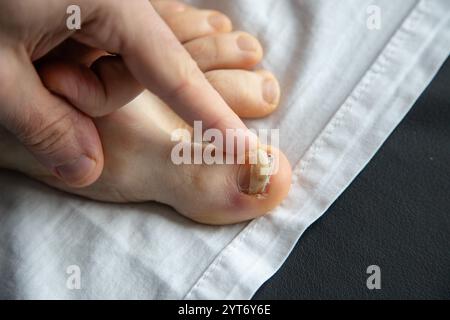 Nahaufnahme des Zehens einer Person mit beschädigtem Zehennagel, der überprüft wird. Das Bild zeigt die Pflege oder Beurteilung eines verletzten Nagels Stockfoto