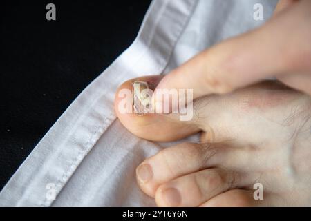 Nahaufnahme des Zehens einer Person mit beschädigtem Zehennagel, der überprüft wird. Das Bild zeigt die Pflege oder Beurteilung eines verletzten Nagels Stockfoto