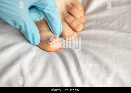 Nahaufnahme eines beschädigten Zehennagels, der von Handschuhen im Innenbereich untersucht wird. Hebt medizinische Versorgung, Hygiene und Aufmerksamkeit auf eine mögliche Pilzinfektion hervor Stockfoto