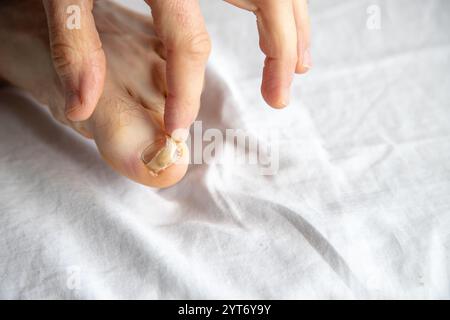 Nahaufnahme des Zehens einer Person mit beschädigtem Zehennagel, der überprüft wird. Das Bild zeigt die Pflege oder Beurteilung eines verletzten Nagels Stockfoto