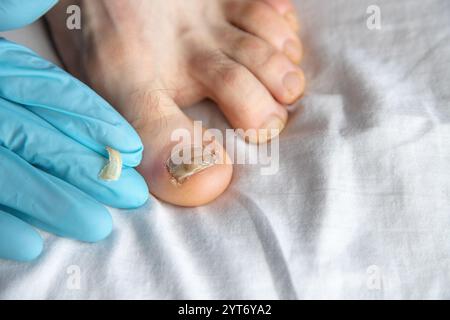 Nahaufnahme eines beschädigten Zehennagels, der von Handschuhen im Innenbereich untersucht wird. Hebt medizinische Versorgung, Hygiene und Aufmerksamkeit auf eine mögliche Pilzinfektion hervor Stockfoto