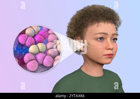 Computerdarstellung eines Kindes mit transparenter Haut, die Otitis Media (Mittelohrinfektion) und Nahaufnahme von Streptococcus pneumoniae-Bakterien zeigt. Stockfoto