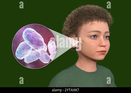 Computerdarstellung eines Kindes mit transparenter Haut, die Otitis Media (Mittelohrinfektion) und Nahaufnahme von Haemophilus influenzae-Bakterien zeigt. Stockfoto