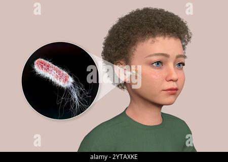 Computerdarstellung eines Kindes mit transparenter Haut, die Otitis Media (Mittelohrinfektion) und Nahaufnahme von Pseudomonas aeruginosa-Bakterien zeigt. Stockfoto