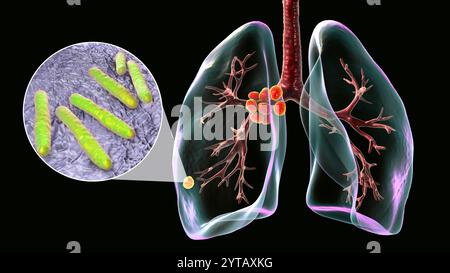 Primäre Lungentuberkulose. Computerillustration mit dem Ghon-Komplex und der mediastinalen Lymphadenitis sowie Nahaufnahme von Mycobacterium tuberculosis-Bakterien. Stockfoto