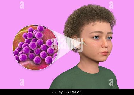 Computerdarstellung eines Kindes mit transparenter Haut, die Otitis Media (Mittelohrinfektion) und Nahaufnahme von Staphylococcus aureus-Bakterien zeigt. Stockfoto