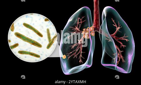 Primäre Lungentuberkulose mit dem Ranke-Komplex. Computerillustration zur Hervorhebung von Lungenläsionen und mediastinaler Lymphadenitis, zusammen mit einer Nahaufnahme von Mycobacterium tuberculosis-Bakterien. Stockfoto