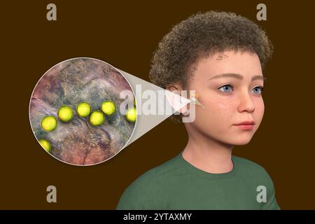 Computerdarstellung eines Kindes mit transparenter Haut, die Otitis Media (Mittelohrinfektion) und Nahaufnahme von Streptococcus pyogenes-Bakterien zeigt. Stockfoto