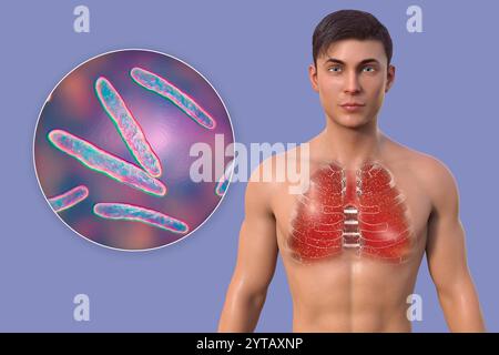 Computerillustration eines Mannes mit transparenter Haut, die von Miliartuberkulose betroffene Lunge freilegt, und Nahaufnahme von Mycobacterium tuberculosis-Bakterien. Stockfoto