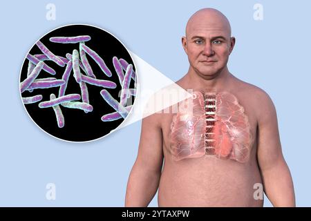 Computerdarstellung eines Mannes mit transparenter Haut, der die Lunge freilegt, die von Sekundärtuberkulose betroffen ist, und Nahaufnahme von Mycobacterium tuberculosis-Bakterien. Stockfoto