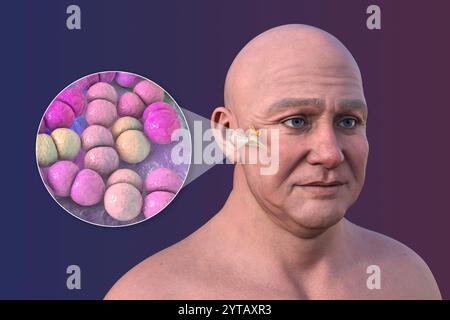 Computerdarstellung eines Mannes mit transparenter Haut, der Otitis Media (Mittelohrinfektion) und Nahaufnahme von Streptococcus pneumoniae-Bakterien zeigt. Stockfoto