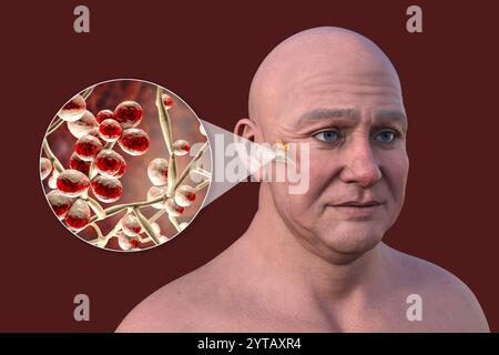 Computerillustration eines Mannes mit transparenter Haut, der eine Pilzassoziierte Otitis Media (Mittelohrinfektion) darstellt, mit Nahaufnahme von Candida-Hefen. Stockfoto