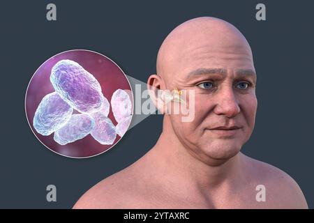 Computerdarstellung eines Mannes mit transparenter Haut, die Otitis Media (Mittelohrinfektion) und Nahaufnahme von Haemophilus influenzae-Bakterien zeigt. Stockfoto