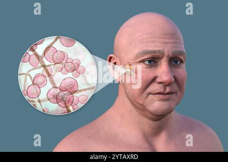 Computerillustration eines Mannes mit transparenter Haut, der eine Pilzassoziierte Otitis Media (Mittelohrinfektion) darstellt, mit Nahaufnahme von Candida-Hefen. Stockfoto