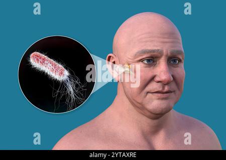 Computerdarstellung eines Mannes mit transparenter Haut, die Otitis Media (Mittelohrinfektion) und Nahaufnahme von Pseudomonas aeruginosa-Bakterien zeigt. Stockfoto