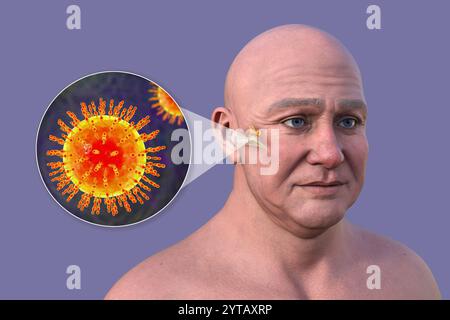 Computerillustration eines Mannes mit transparenter Haut, die virale Mittelohrentzündung (Mittelohrentzündung) und eine Nahaufnahme von Viren wie respiratorischem Synzytial-Virus, Influenza und Rhinovirus zeigt. Stockfoto