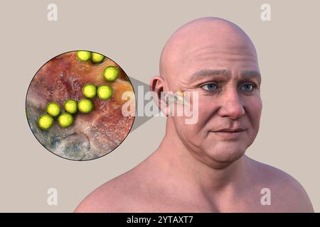 Computerdarstellung eines Mannes mit transparenter Haut, die Otitis Media (Mittelohrinfektion) und Nahaufnahme von Streptococcus pyogenes-Bakterien zeigt. Stockfoto