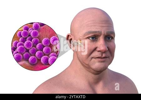 Computerdarstellung eines Mannes mit transparenter Haut, die Otitis Media (Mittelohrinfektion) und Nahaufnahme von Staphylococcus aureus-Bakterien zeigt. Stockfoto