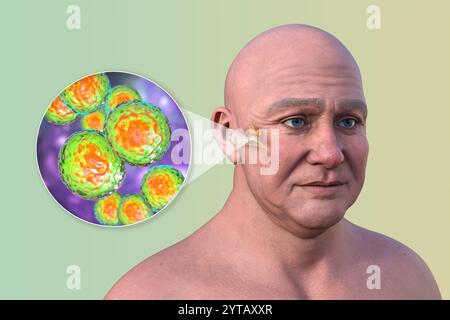Computerdarstellung eines Mannes mit transparenter Haut, die Otitis Media (Mittelohrinfektion) und Nahaufnahme von Moraxella catarrhalis-Bakterien zeigt. Stockfoto