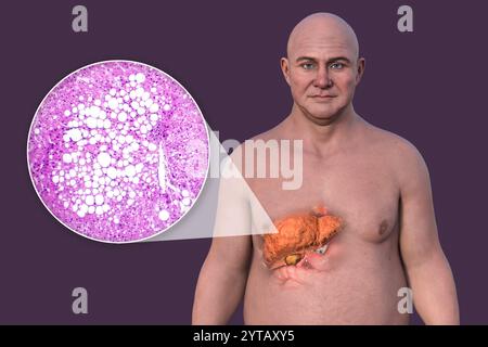 Computerillustration eines Mannes mit transparenter Haut, die eine Fettleber enthüllt, die Leberanatomie und Fettansammlung hervorhebt, sowie eine Lichtmikrographie der Lebersteatose. Stockfoto