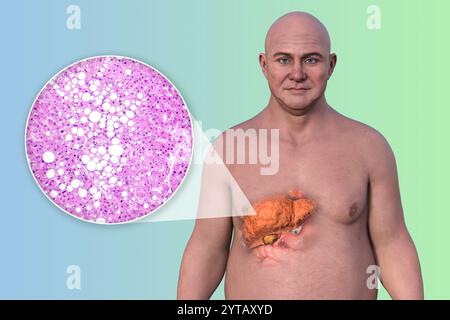 Computerillustration eines Mannes mit transparenter Haut, die eine Fettleber enthüllt, die Leberanatomie und Fettansammlung hervorhebt, sowie eine Lichtmikrographie der Lebersteatose. Stockfoto