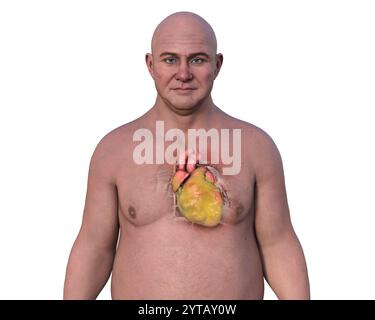 Computerillustration eines Mannes mittleren Alters mit transparenter Haut, das ein adipöses Herz mit sichtbaren Fettablagerungen um das Herz zeigt. Stockfoto