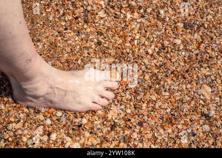 Der Fuß einer alten Frau mit gelbem großen Zehennagel auf Seesand mit Muscheln. Nagelpilz. Stockfoto