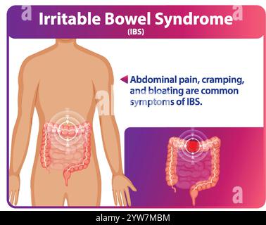 Abbildung der Symptome des RDS und der betroffenen Bereiche Stock Vektor