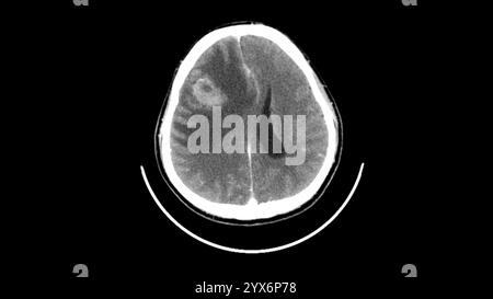 Axiale Computertomographie (CT) des Kopfes mit einem intraaxialen Tumor (hellgrau) im rechten Frontallappen des Gehirns. Stockfoto