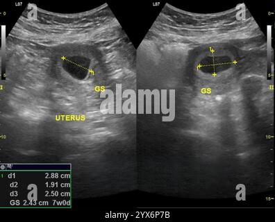 Ultraschallaufnahmen einer Gebärmutter, die den Gestationssack (GS) um einen 7 Wochen alten menschlichen Embryo zeigen. Der Gestationssack bildet sich etwa 5 bis 7 Wochen nach der letzten Menstruationsperiode. Es wird zur Plazenta, dem temporären Organ, das einen Fötus mit seiner Mutter verbindet. Stockfoto