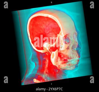 Farbige Computertomographie (CT) eines gesunden Schädels. Stockfoto