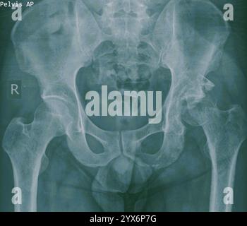 Die Röntgenaufnahme des Beckens eines Patienten mit einer Acetabulumfraktur (weiß, rechts). Das Acetabulum ist die konkave Oberfläche des Beckens, wo der Kopf des Femurs (Oberschenkelknochen) mit ihm trifft und das Hüftgelenk bildet. Diese Verletzung wurde bei einem Verkehrsunfall verursacht. Stockfoto