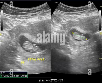 Ultraschallaufnahmen eines Uterus mit einem menschlichen Fötus nach 9 Wochen. In diesem Stadium misst der Fetus etwa 4 Zentimeter. Stockfoto