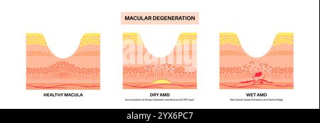 Nasse und trockene Makuladegeneration, Illustration. Stockfoto
